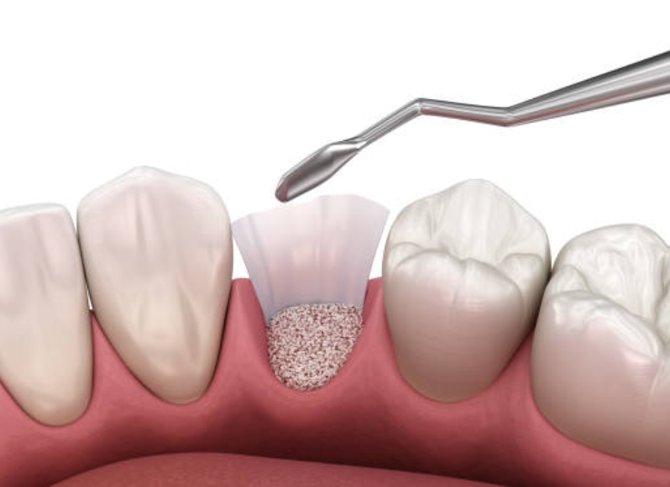 Bone Grafting